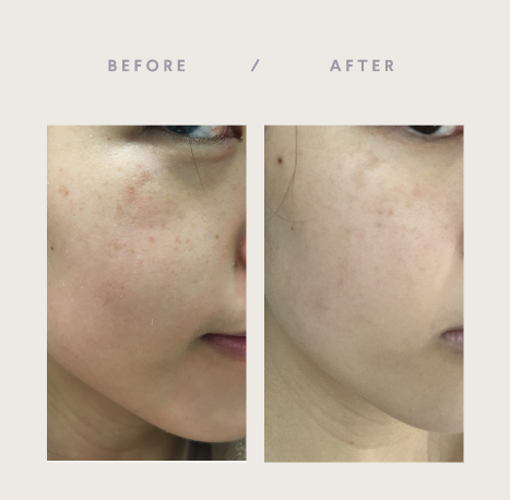 Curology before and after dark spots