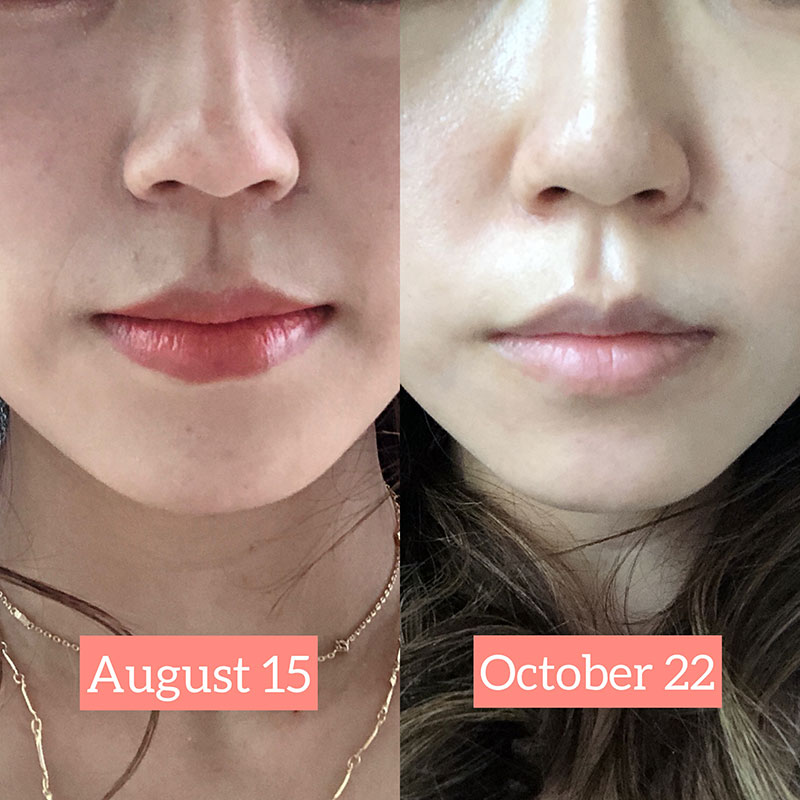 Tripollar Stop X review - before and after