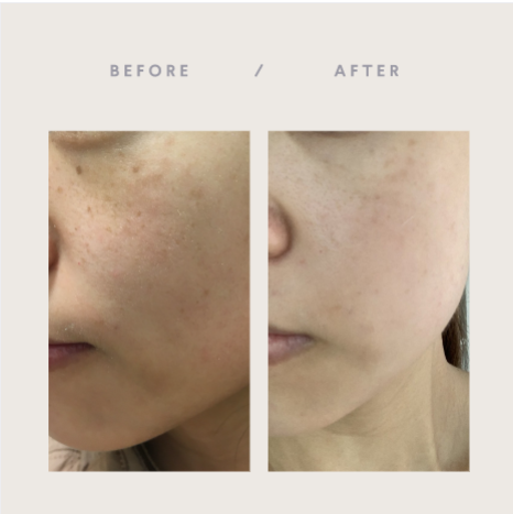 Curology before and after dark spots