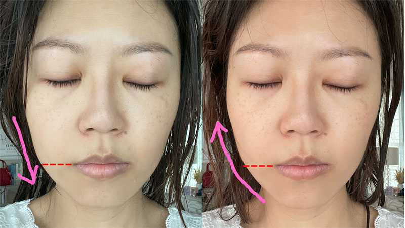Tripollar Stop Vx before and after - DMA mode