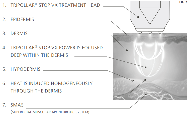 How the Tripollar Stop X works