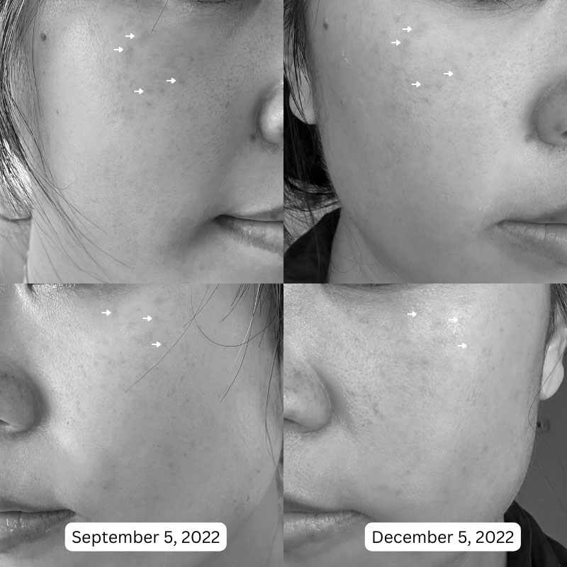 Agency Dark Spot Formula Before & After