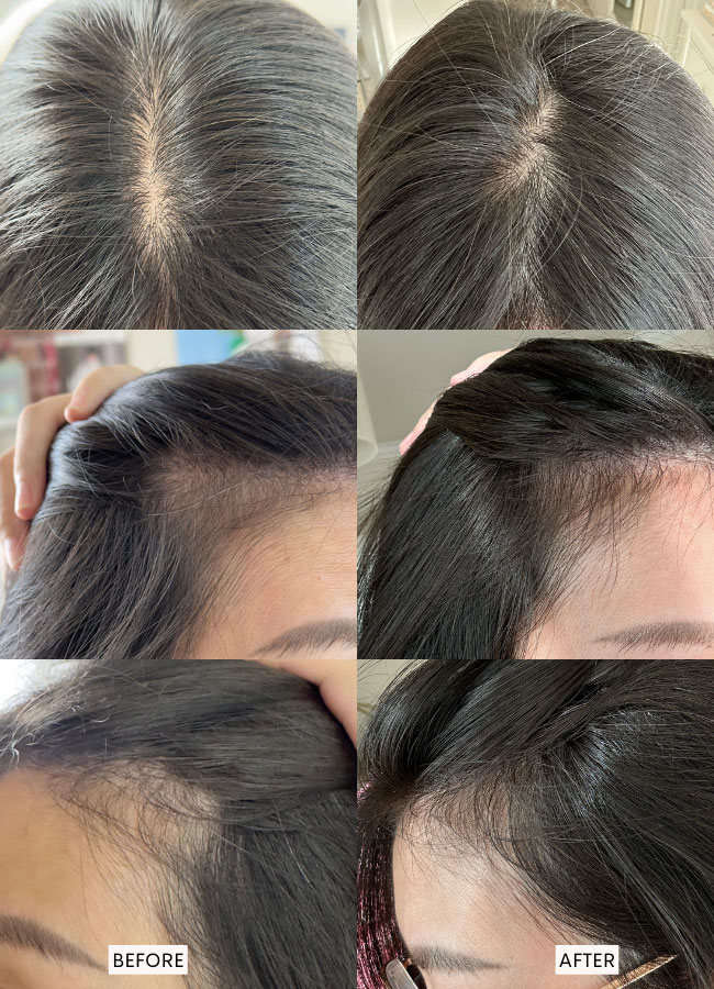 CurrentBody Skin LED Hair Regrowth Device before and after